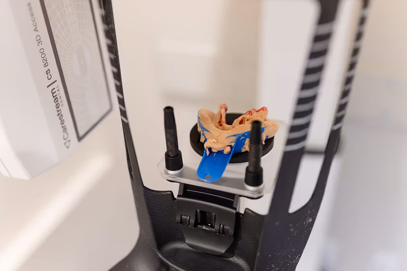 Digital impression technology used at The Pampered Tooth.