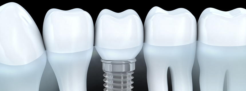Dental Implants Daytona Beach